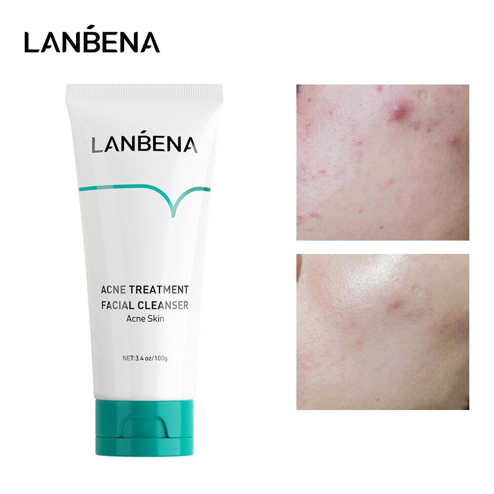 LANBENA  Mụn Sữa Rửa Mặt Oligopeptide Hiệu Quả Chống Mụn Trứng Cá Dầu Miễn Phí Nhẹ Dày Đặc Bọt Thông Thoáng Lỗ Chân Lông Rõ Ràng Mụn