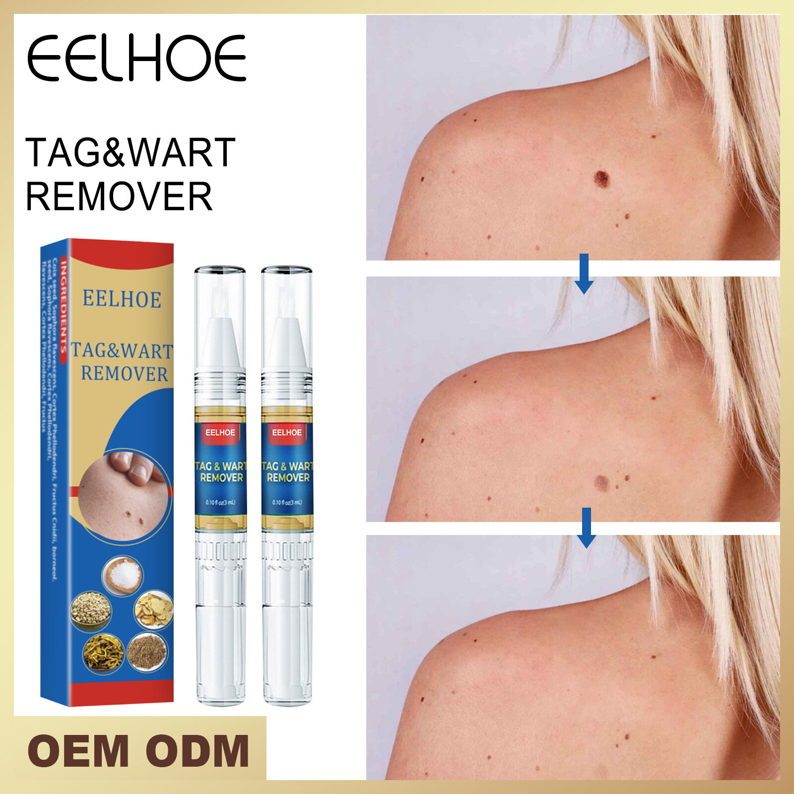 Efero thanh loại bỏ mụn cóc dung dịch loại bỏ mụn cóc kháng khuẩn rất hiệu quả * 2