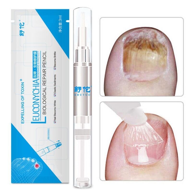 Bút điều trị móng tay bằng dầu biểu bì, serum chống nấm dung dịch chăm sóc móng sửa móng nấm lỏng loại bỏ nấm móng, 3ml
