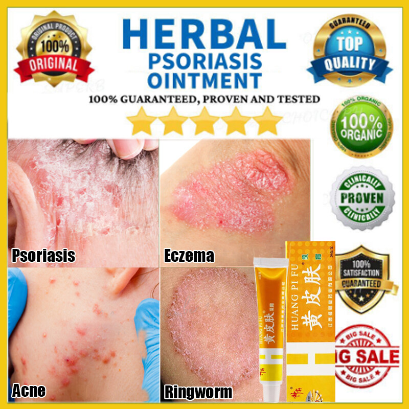 BEST SELLER Herbal Anti Fungal Cream, Treat Skin Rashes, Stop Itching