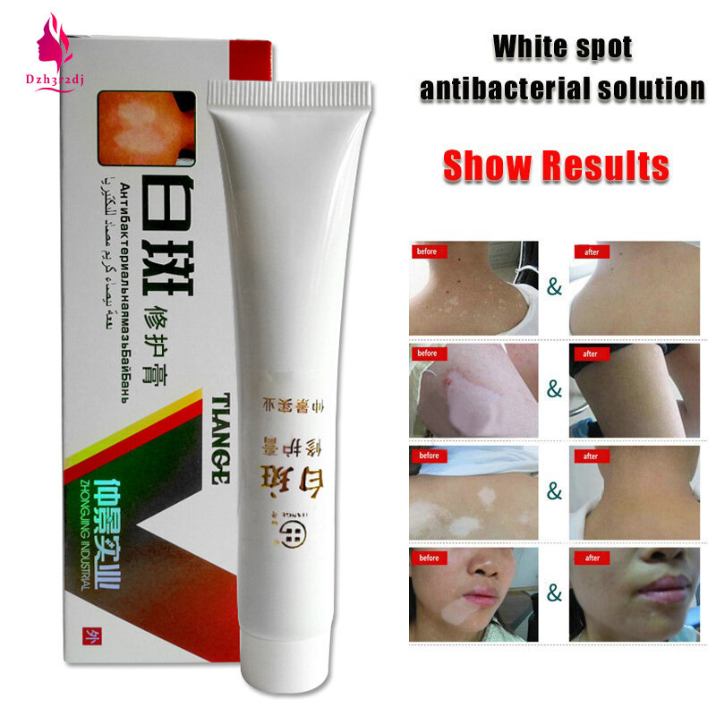 Kem Thảo Dược Trung Quốc OH-Beauty Trị Bạch Biến Đốm Trắng Leukoplakia Trị Bệnh Thảo Dược Melanin Thúc Đẩy Điều Trị Bệnh Phụ Kiện Kem Thảo Dược Trung Quốc Trị Bạch Biến Đốm Trắng Cho Bạch Cầu