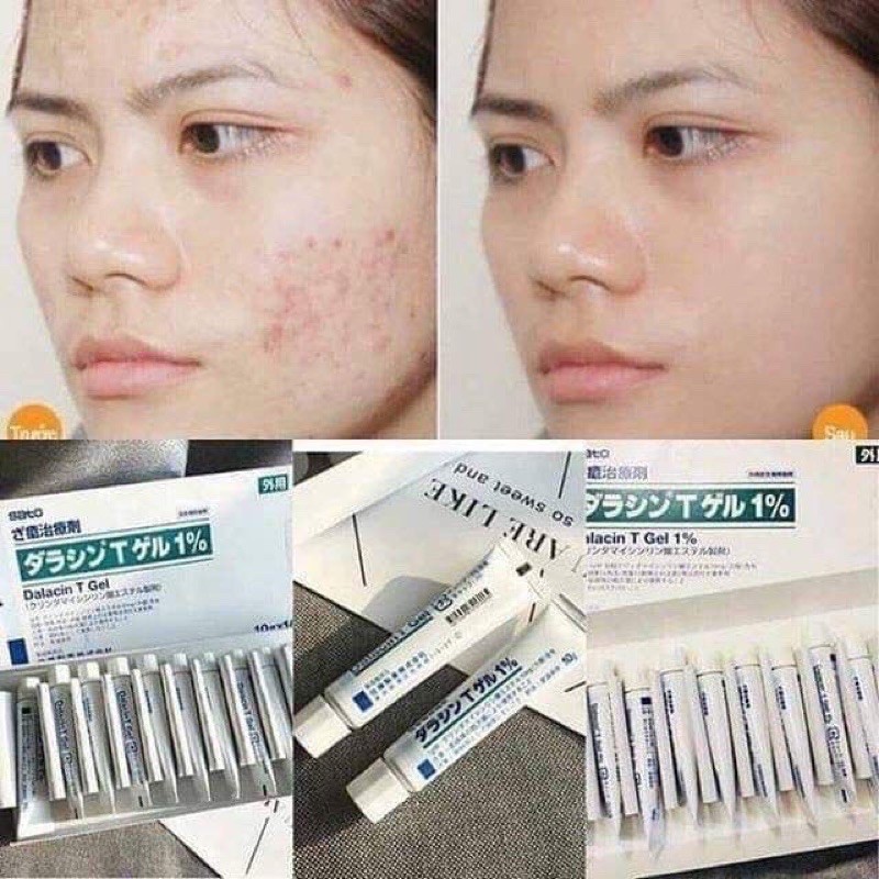 Gel mụn nhật - gel giảm mụn gentacin 1% nhật