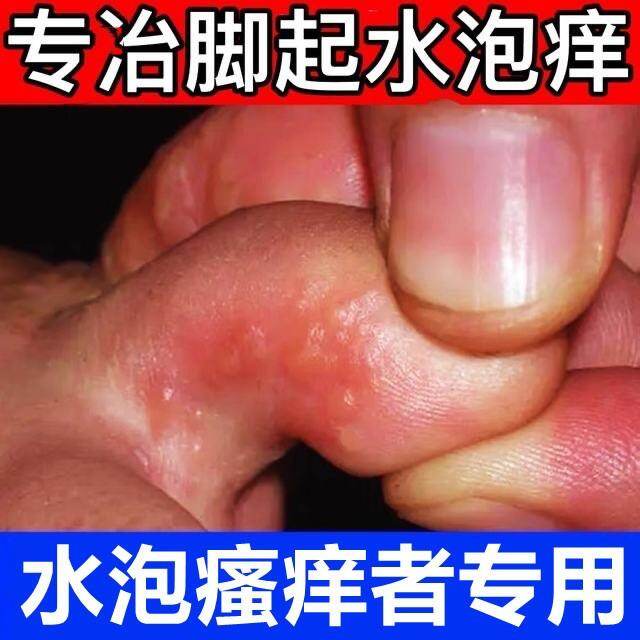 Thuốc trị viêm chân cho vận động viên chữa ngứa mụn nước nhiễm trùng chân thật thuốc trị thối chân bong tróc đường nối ngón chân mụn nước nhỏ ngứa thối