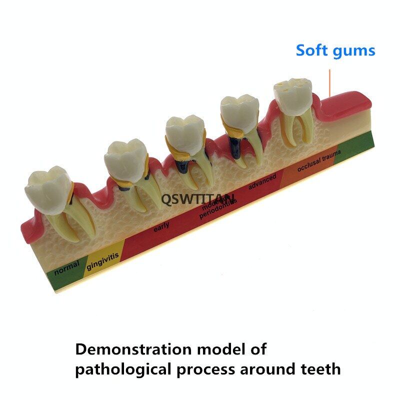 Jiayi Odontologia Periodontal Disease Dental Teeth Model Tooth Research