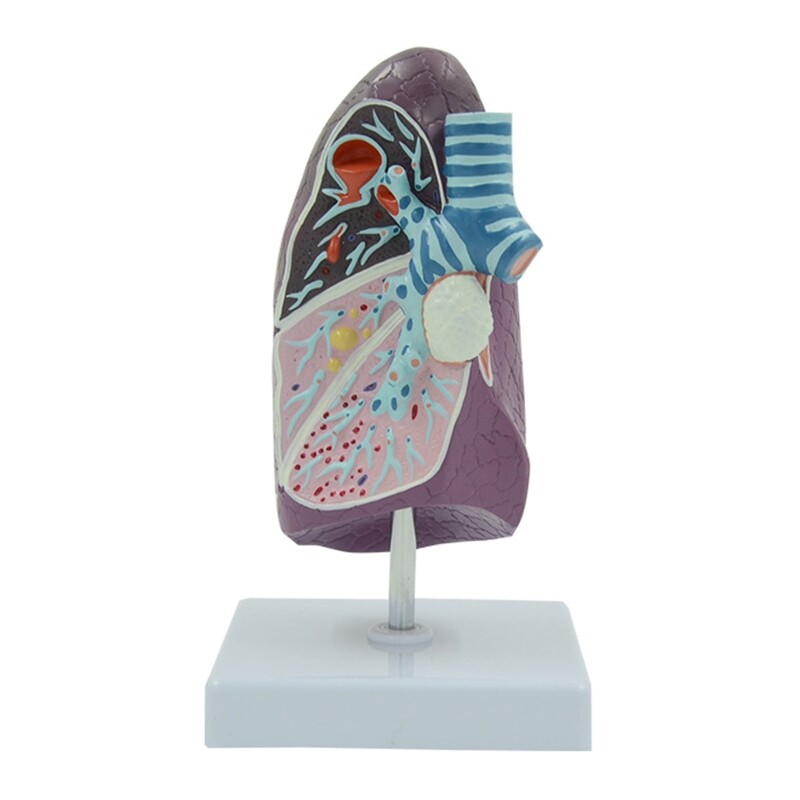 Anatomical Pathological Lung Model Shows Lung Cancer Pneumonia